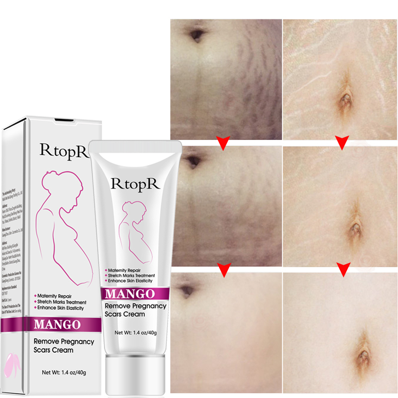 Pregnancy Cream Mango Remove Repair Suitable For Any Shin Type